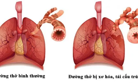 Giải pháp hỗ trợ mới cho tình trạng ho kéo dài, đờm nhiều vì viêm phế quản tái phát liên tục