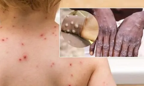 Triệu chứng của bệnh đậu mùa khỉ? Tỷ lệ tử vong là bao nhiêu?