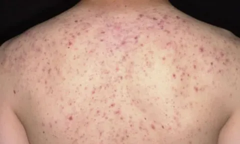 Sốc phản vệ, nguy kịch vì bôi thuốc tê để trị mụn ở lưng