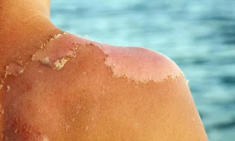 Phòng bệnh ngoài da thường gặp trong mùa hè