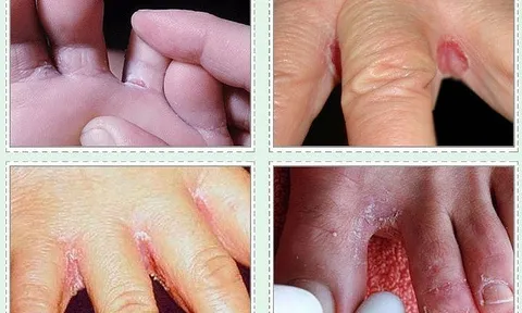 Phòng các bệnh về da khi mùa mưa đến