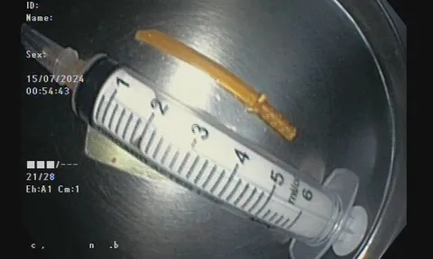 Bé 33 tháng tuổi nuốt mảnh đồ chơi vào dạ dày