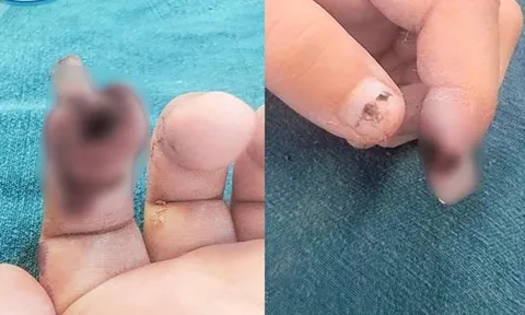 Bé 3 tuổi nhập viện vì kẹp tay vào cửa khi đi siêu thị