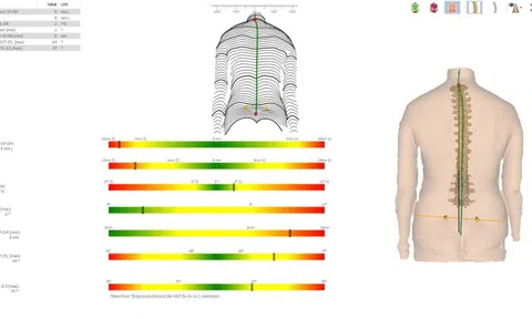 Lý giải thành công của phương pháp cong vẹo cột sống tiêu chuẩn Nhật tại MYREHAB MATSUOKA