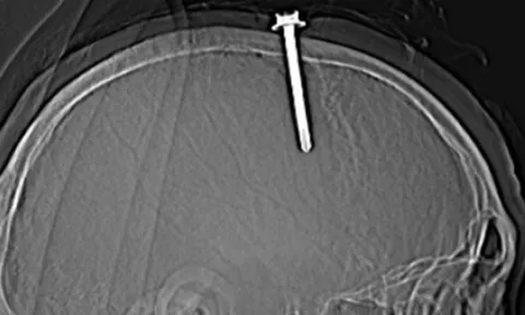 Phẫu thuật lấy chiếc đinh cắm vào đầu người đàn ông hơn một năm