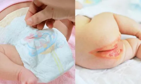 Nguy hại từ việc sử dụng bỉm không rõ nguồn gốc